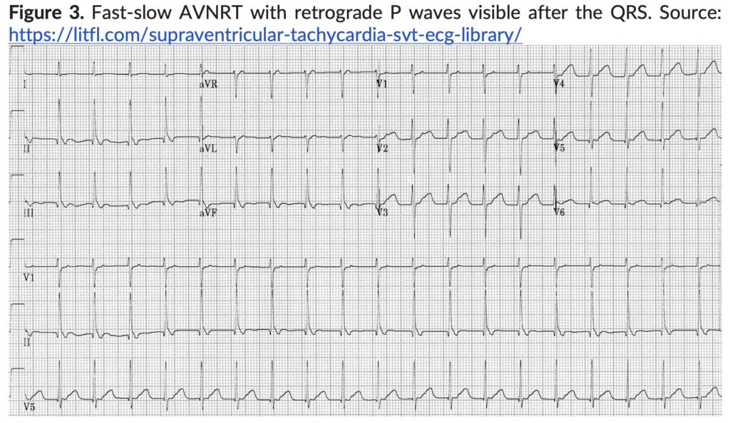 Figure 3. Fast-slow AVNRT with retrograde P waves. 